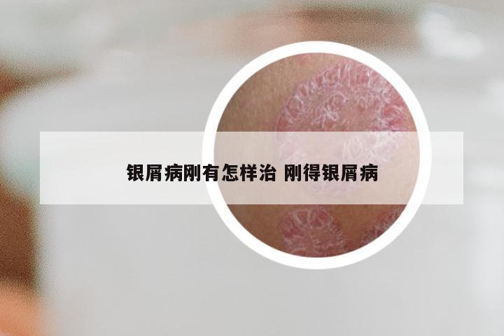 银屑病刚有怎样治 刚得银屑病