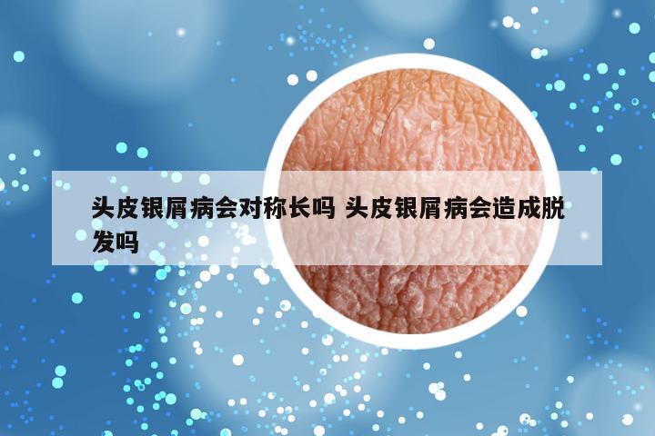 头皮银屑病会对称长吗 头皮银屑病会造成脱发吗
