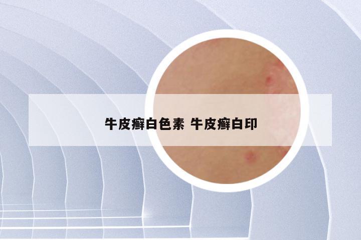 牛皮癣白色素 牛皮癣白印