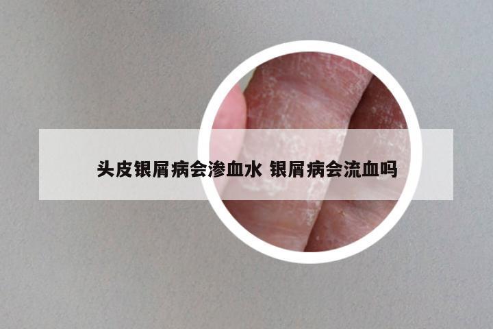 头皮银屑病会渗血水 银屑病会流血吗