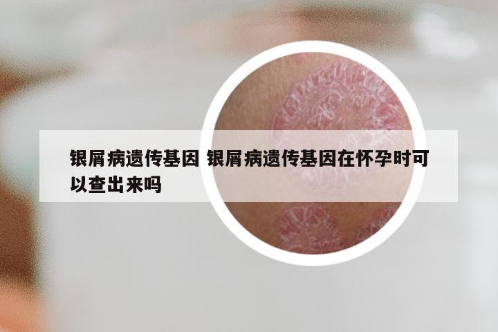 银屑病遗传基因 银屑病遗传基因在怀孕时可以查出来吗