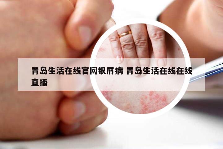 青岛生活在线官网银屑病 青岛生活在线在线直播