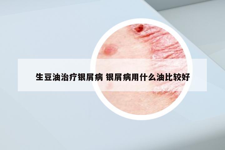 生豆油治疗银屑病 银屑病用什么油比较好