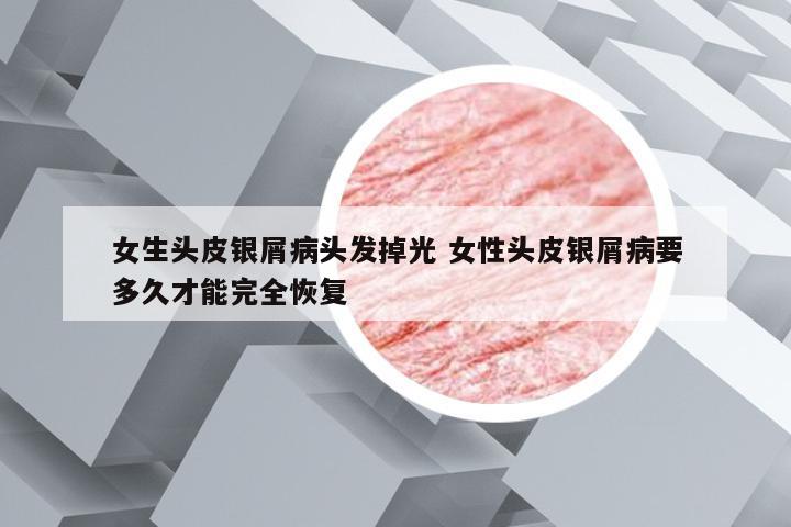 女生头皮银屑病头发掉光 女性头皮银屑病要多久才能完全恢复