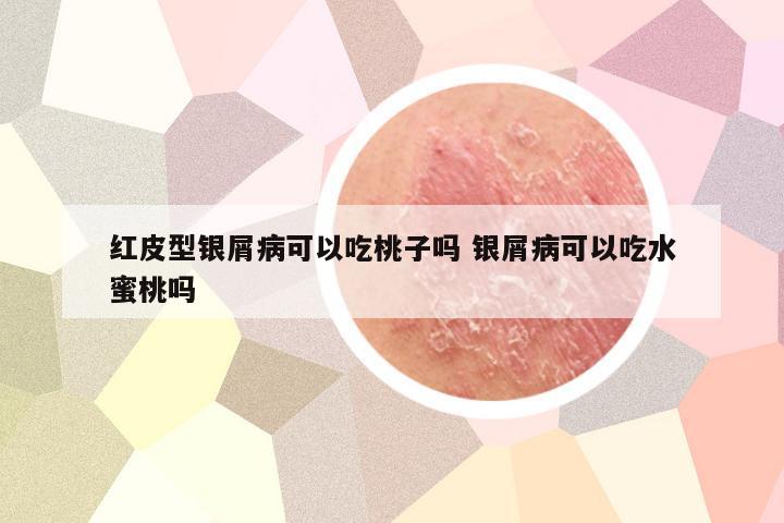 红皮型银屑病可以吃桃子吗 银屑病可以吃水蜜桃吗