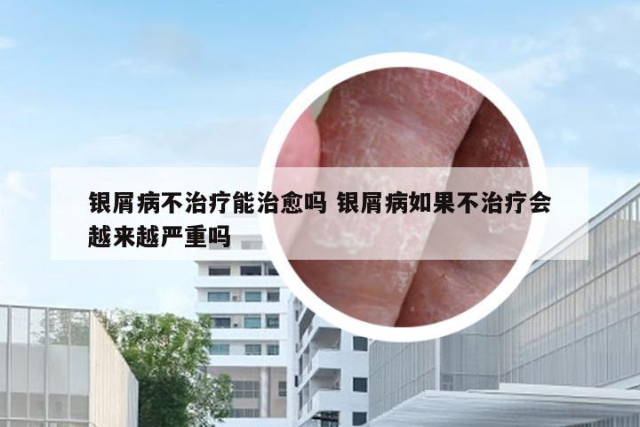 银屑病不治疗能治愈吗 银屑病如果不治疗会越来越严重吗