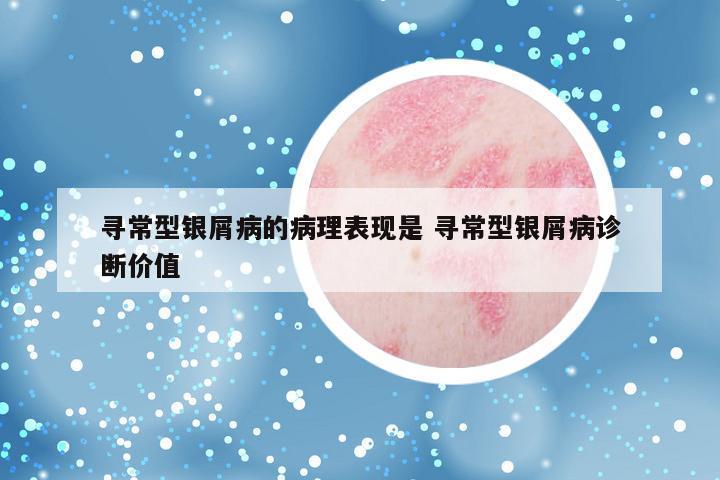 寻常型银屑病的病理表现是 寻常型银屑病诊断价值