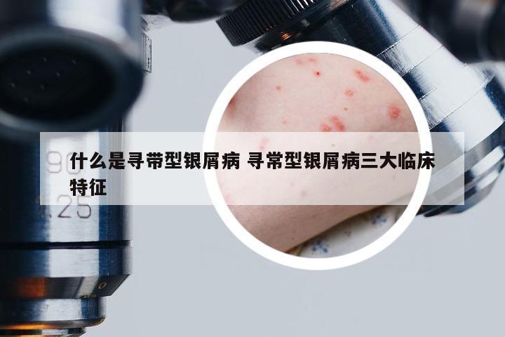 什么是寻带型银屑病 寻常型银屑病三大临床特征