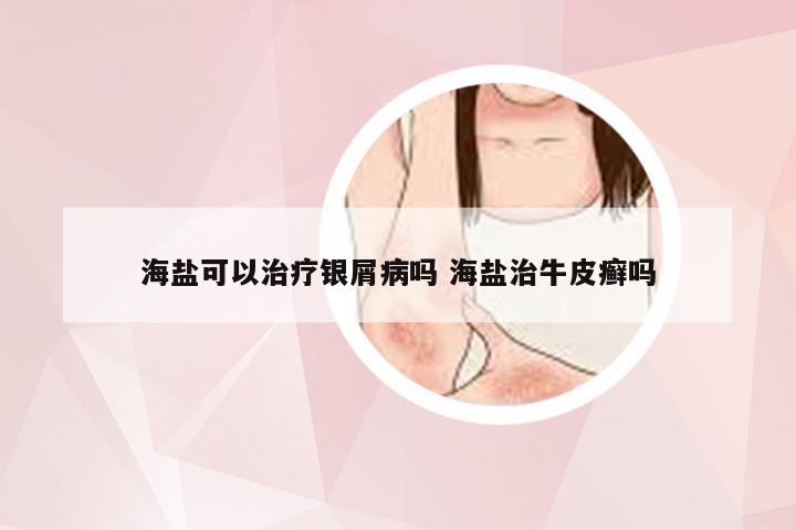 海盐可以治疗银屑病吗 海盐治牛皮癣吗