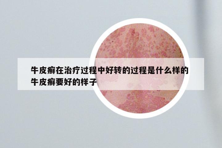 牛皮癣在治疗过程中好转的过程是什么样的 牛皮癣要好的样子