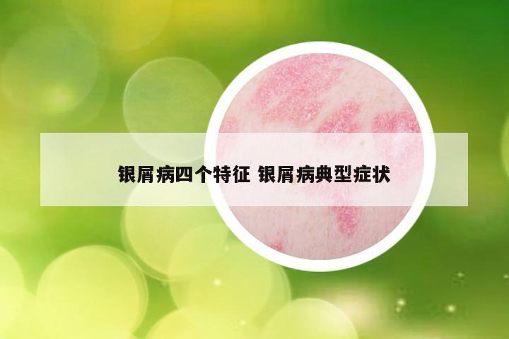 银屑病四个特征 银屑病典型症状