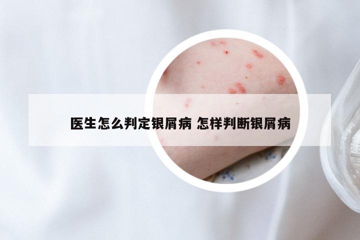 医生怎么判定银屑病 怎样判断银屑病