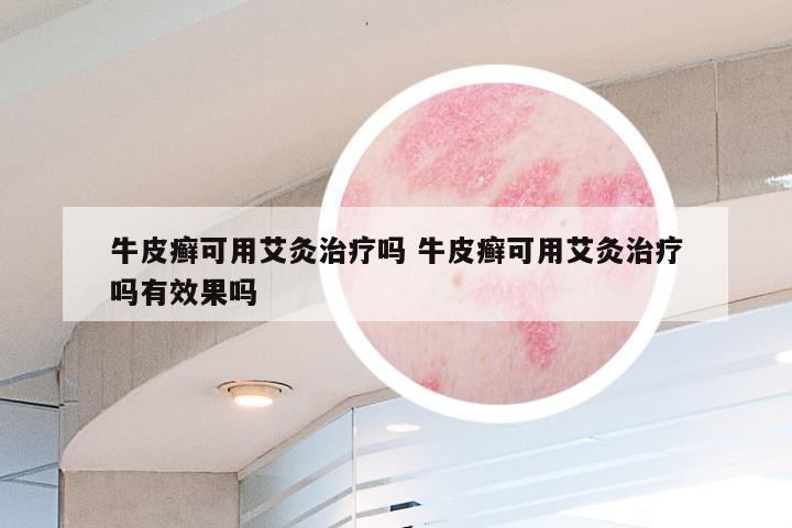 牛皮癣可用艾灸治疗吗 牛皮癣可用艾灸治疗吗有效果吗