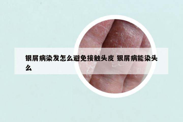 银屑病染发怎么避免接触头皮 银屑病能染头么