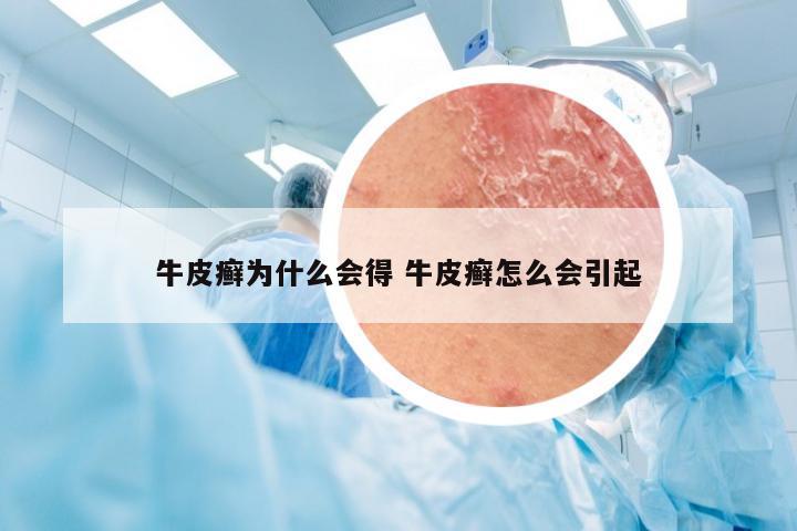牛皮癣为什么会得 牛皮癣怎么会引起