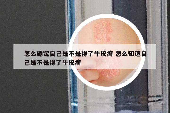 怎么确定自己是不是得了牛皮癣 怎么知道自己是不是得了牛皮癣