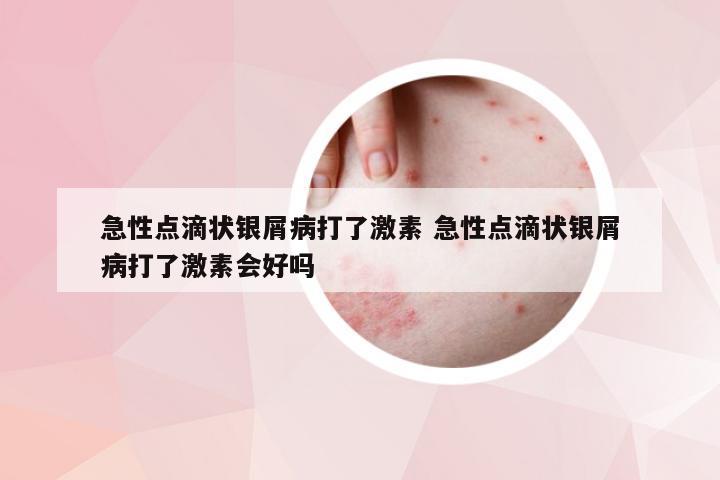 急性点滴状银屑病打了激素 急性点滴状银屑病打了激素会好吗