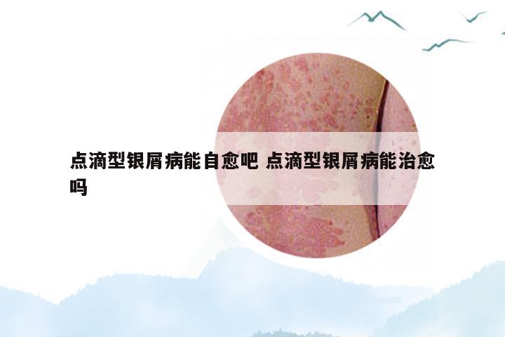 点滴型银屑病能自愈吧 点滴型银屑病能治愈吗