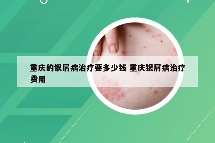 重庆的银屑病治疗要多少钱 重庆银屑病治疗费用