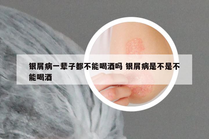 银屑病一辈子都不能喝酒吗 银屑病是不是不能喝酒