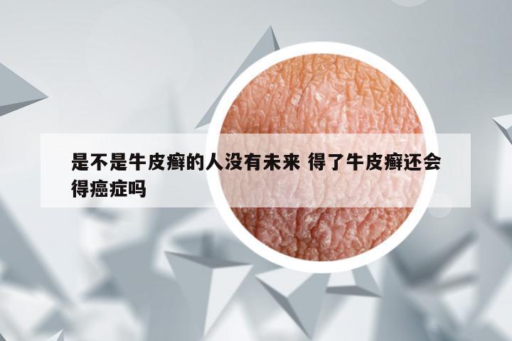 是不是牛皮癣的人没有未来 得了牛皮癣还会得癌症吗