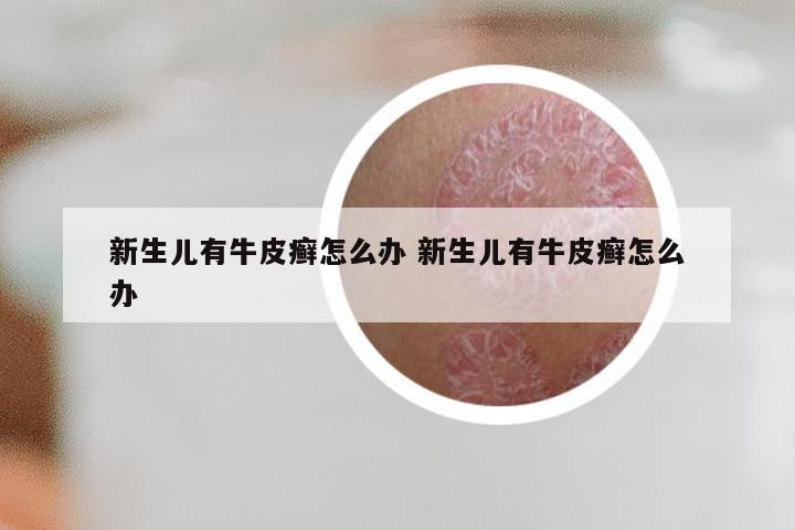 新生儿有牛皮癣怎么办 新生儿有牛皮癣怎么办