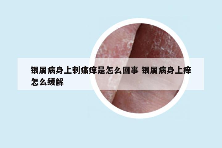 银屑病身上刺痛痒是怎么回事 银屑病身上痒怎么缓解
