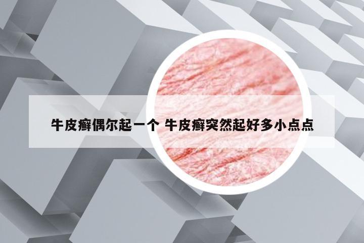 牛皮癣偶尔起一个 牛皮癣突然起好多小点点