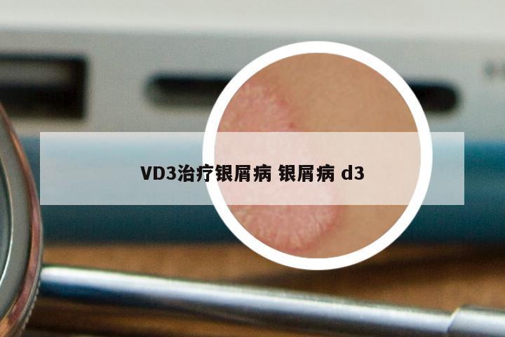 VD3治疗银屑病 银屑病 d3