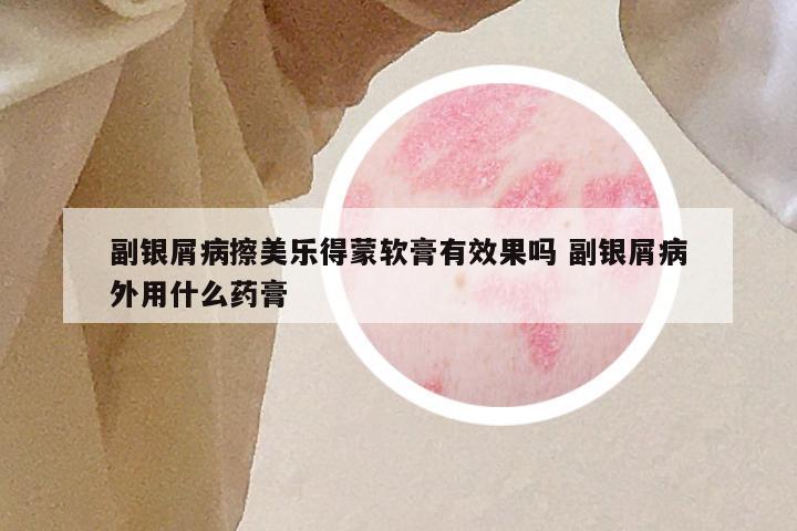 副银屑病擦美乐得蒙软膏有效果吗 副银屑病外用什么药膏