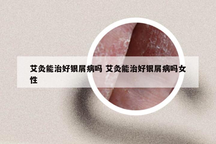 艾灸能治好银屑病吗 艾灸能治好银屑病吗女性