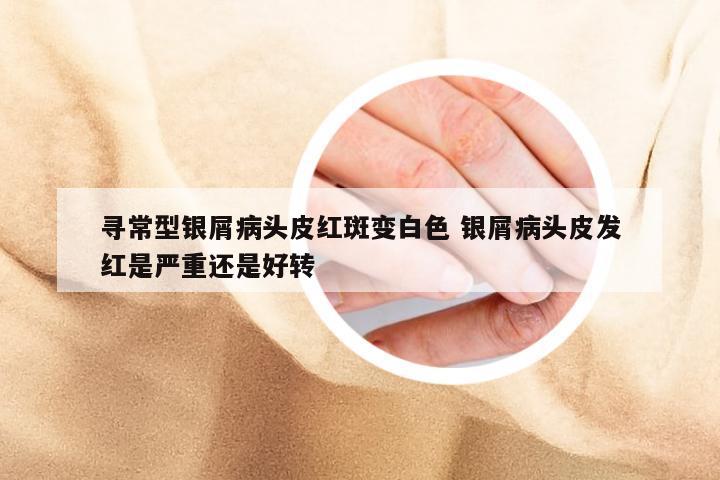 寻常型银屑病头皮红斑变白色 银屑病头皮发红是严重还是好转