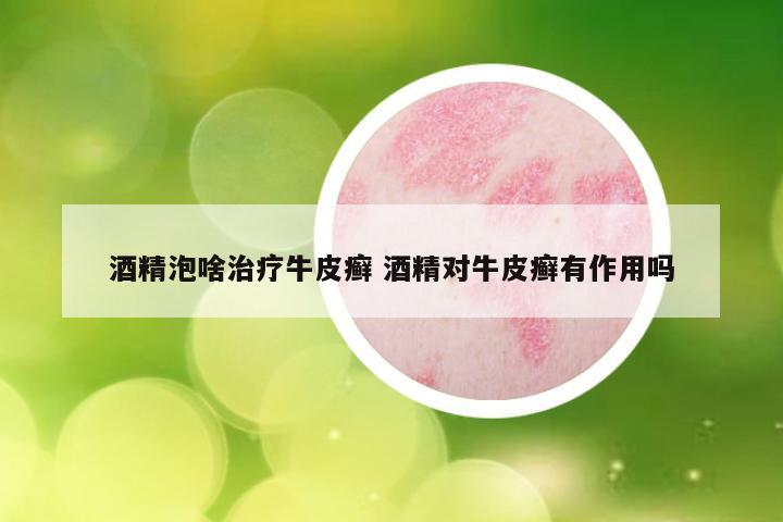 酒精泡啥治疗牛皮癣 酒精对牛皮癣有作用吗
