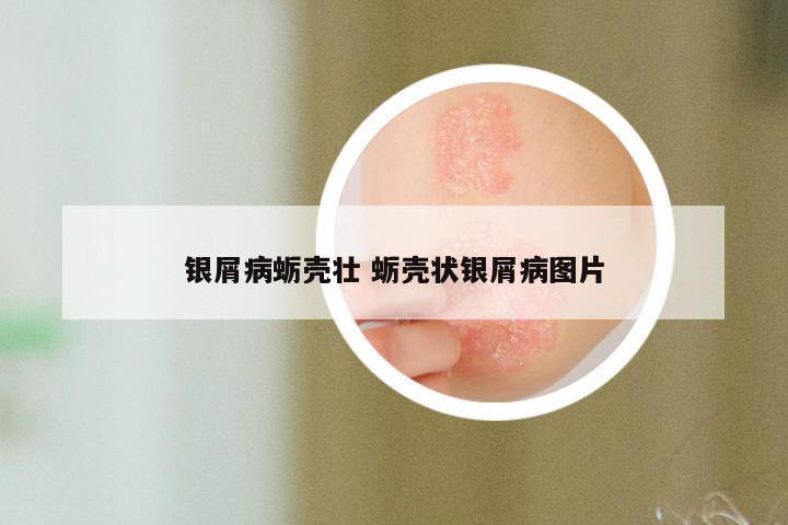 银屑病蛎壳壮 蛎壳状银屑病图片