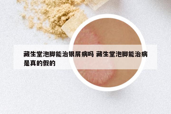 藏生堂泡脚能治银屑病吗 藏生堂泡脚能治病是真的假的