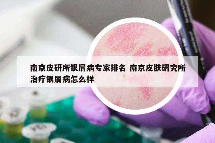 南京皮研所银屑病专家排名 南京皮肤研究所治疗银屑病怎么样