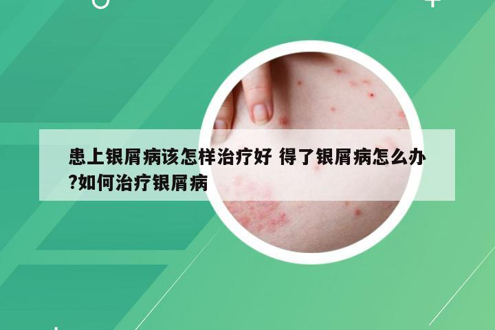 患上银屑病该怎样治疗好 得了银屑病怎么办?如何治疗银屑病
