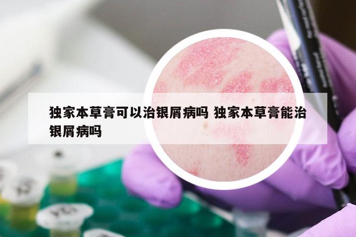 独家本草膏可以治银屑病吗 独家本草膏能治银屑病吗