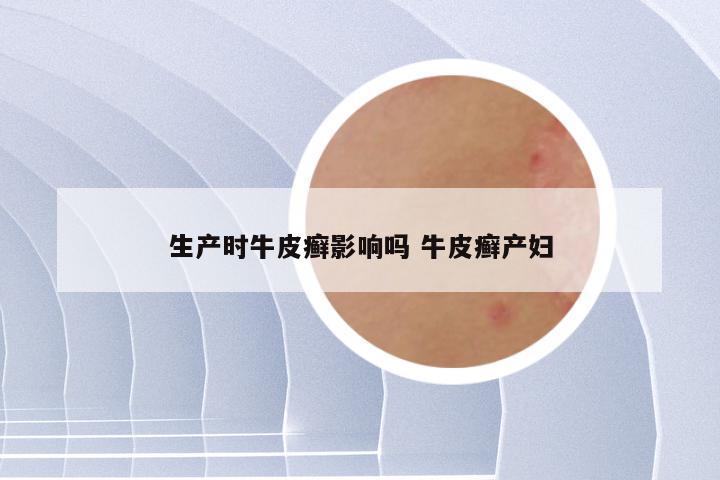 生产时牛皮癣影响吗 牛皮癣产妇