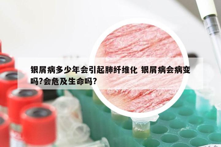 银屑病多少年会引起肺纤维化 银屑病会病变吗?会危及生命吗?