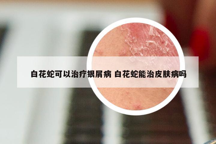 白花蛇可以治疗银屑病 白花蛇能治皮肤病吗