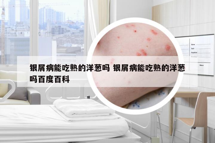 银屑病能吃熟的洋葱吗 银屑病能吃熟的洋葱吗百度百科