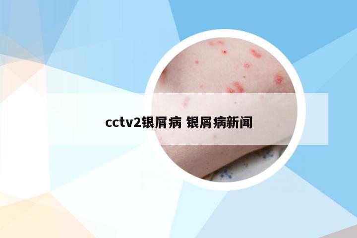 cctv2银屑病 银屑病新闻