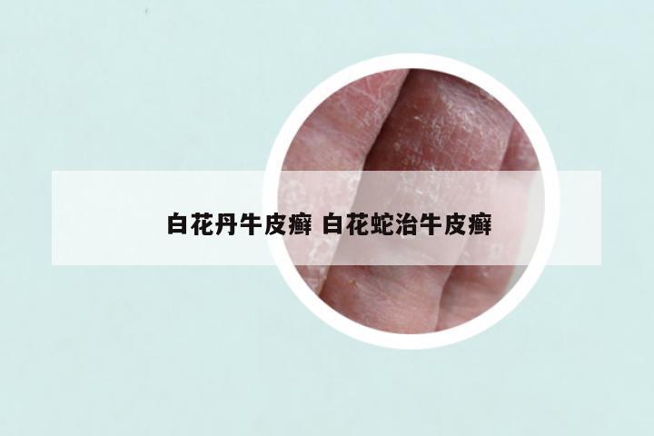 白花丹牛皮癣 白花蛇治牛皮癣