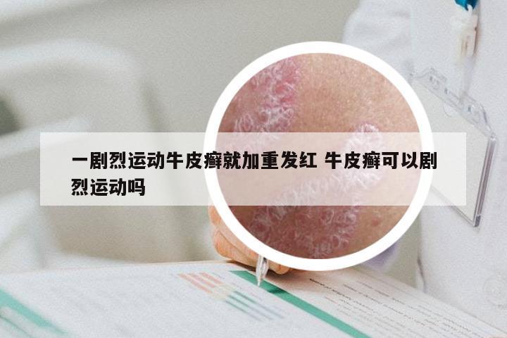 一剧烈运动牛皮癣就加重发红 牛皮癣可以剧烈运动吗
