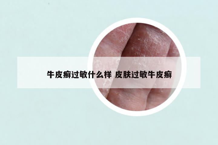 牛皮癣过敏什么样 皮肤过敏牛皮癣