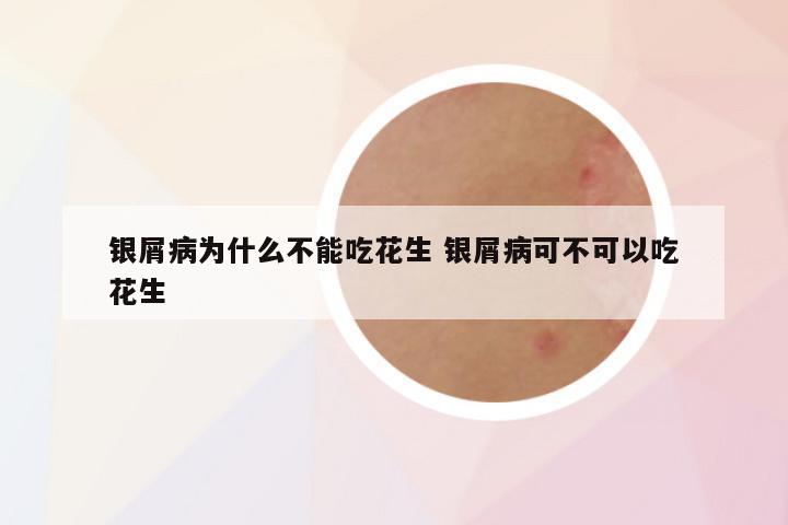 银屑病为什么不能吃花生 银屑病可不可以吃花生