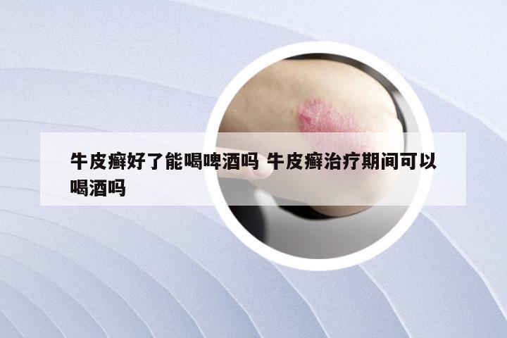 牛皮癣好了能喝啤酒吗 牛皮癣治疗期间可以喝酒吗