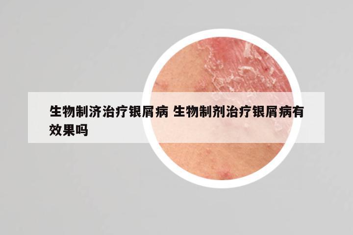 生物制济治疗银屑病 生物制剂治疗银屑病有效果吗
