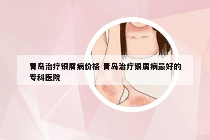 青岛治疗银屑病价格 青岛治疗银屑病最好的专科医院